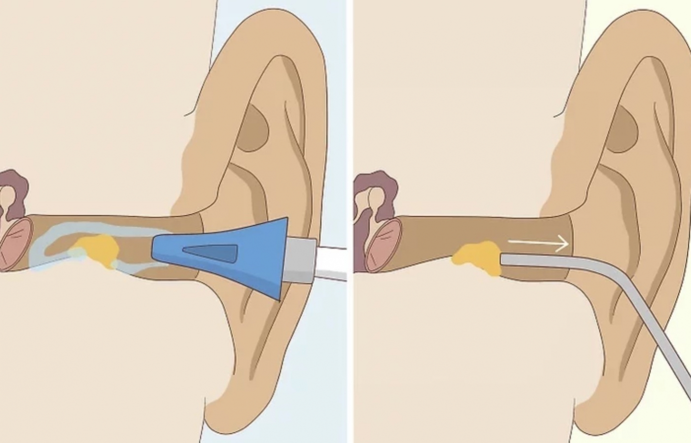How To Get Rid Of Ear Wax Buildup